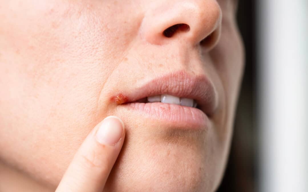 Posso ir ao dentista se estiver com herpes labial ativo?
